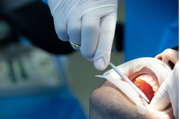 Dental Restorations (Fillings)