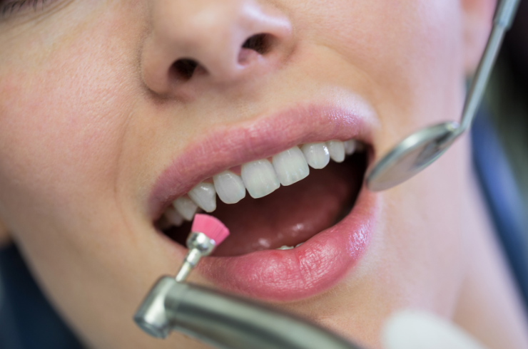 Teeth Scaling & Cleaning